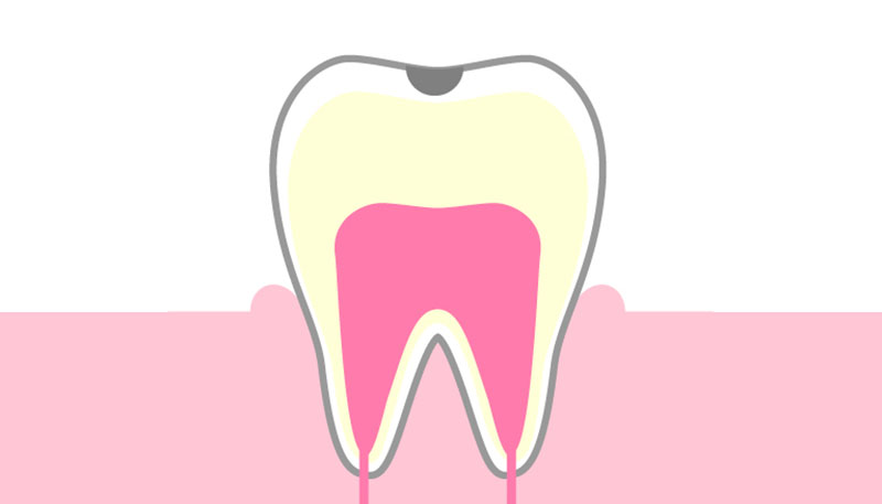 C2：歯の表面の虫歯