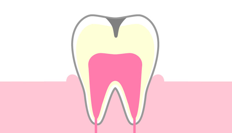 C2：歯の内面の虫歯