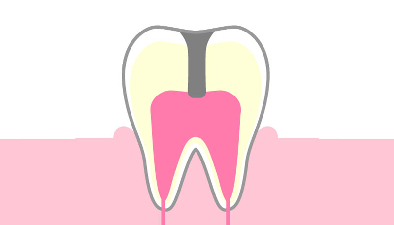 C2：歯の神経にまで達した虫歯