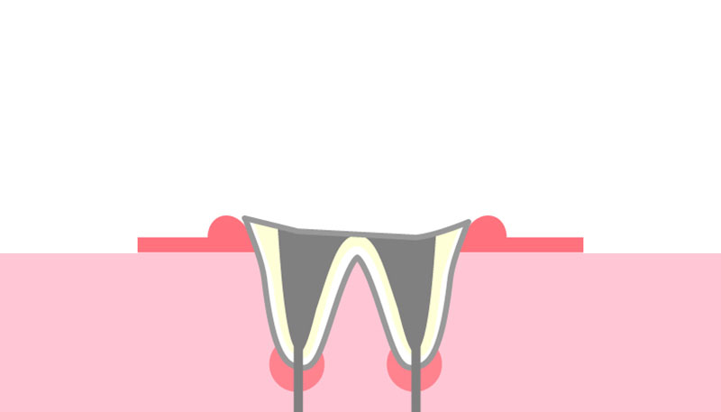 C2：歯の根元のみ残っている虫歯
